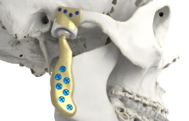 Customized Medical Device & Implant Solutions