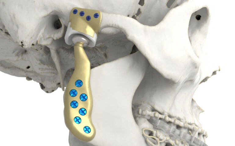 Customized Medical Implants