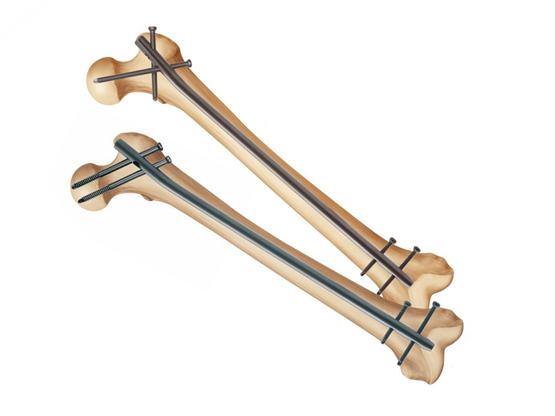 Intra Nailing Systems