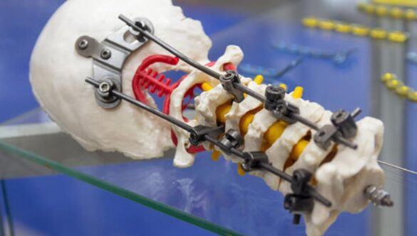 How Surgical Implants Transform Patient Outcomes