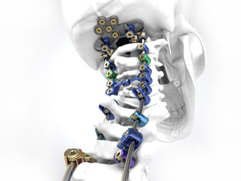 Spinal Internal Fixation System copy
